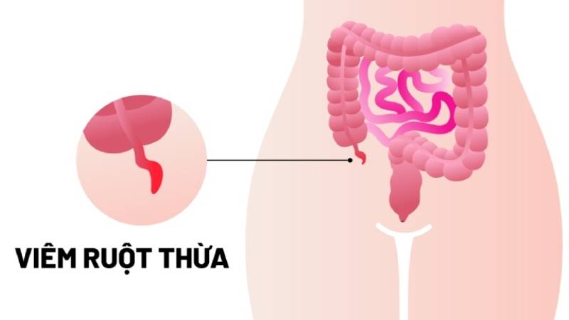 sau mổ ruột thừa uống nước mía được không